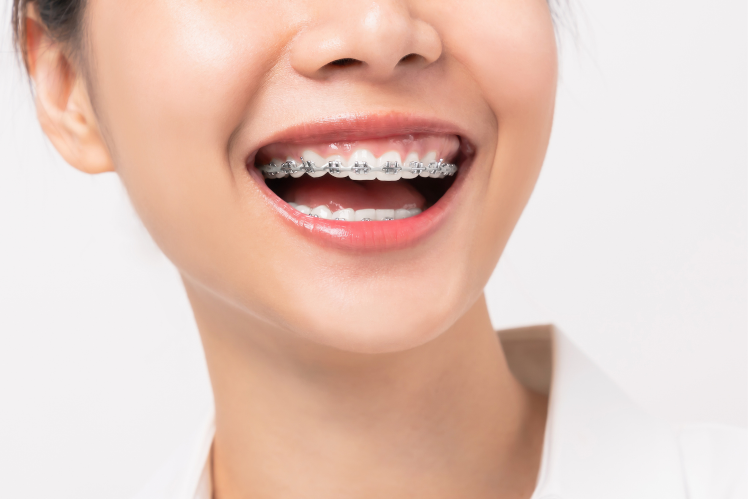 Close-up of a smiling mouth with braces on straight teeth.