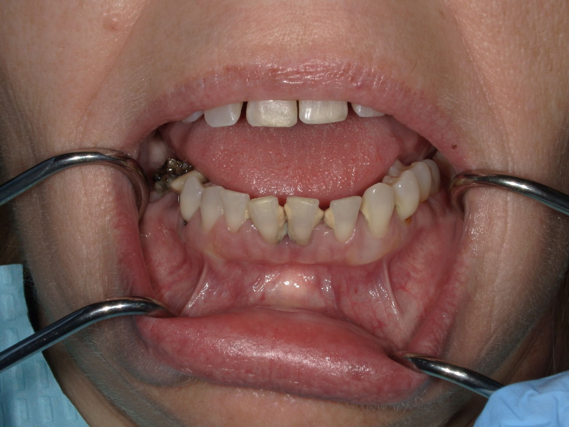 Mouth open, showing teeth and gums held open by cheek retractors during a dental examination.