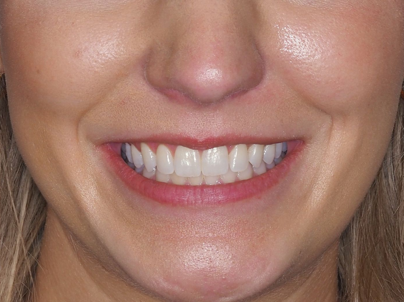 Close-up of a person smiling, showing white teeth, pink lips, and a fair complexion.