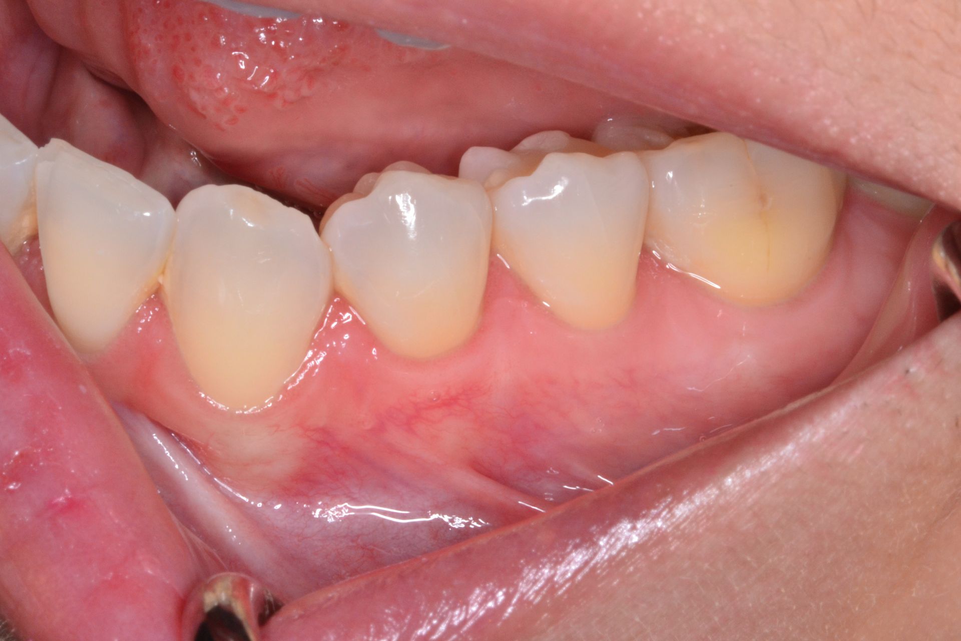 Close-up view of a person's lower teeth and gums, showing slight yellowing and healthy pink gums.