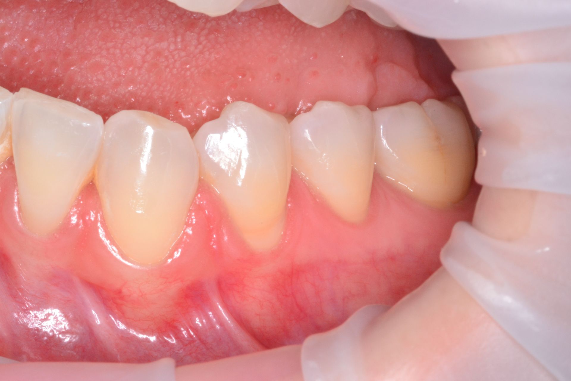 Close-up of a person's teeth and gums in a dental setting.