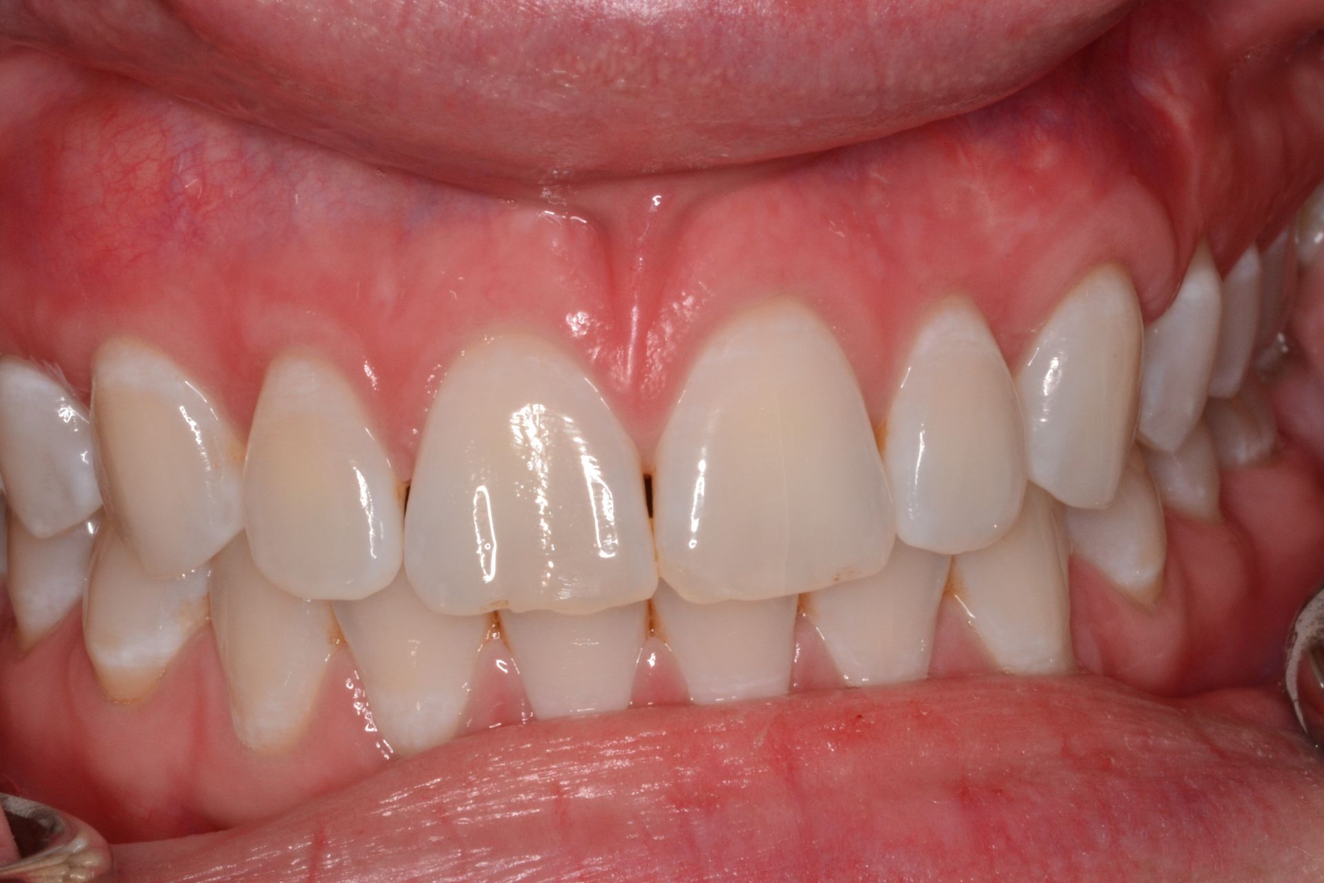 Close-up of a person's teeth. White teeth, pink gums, lips visible.