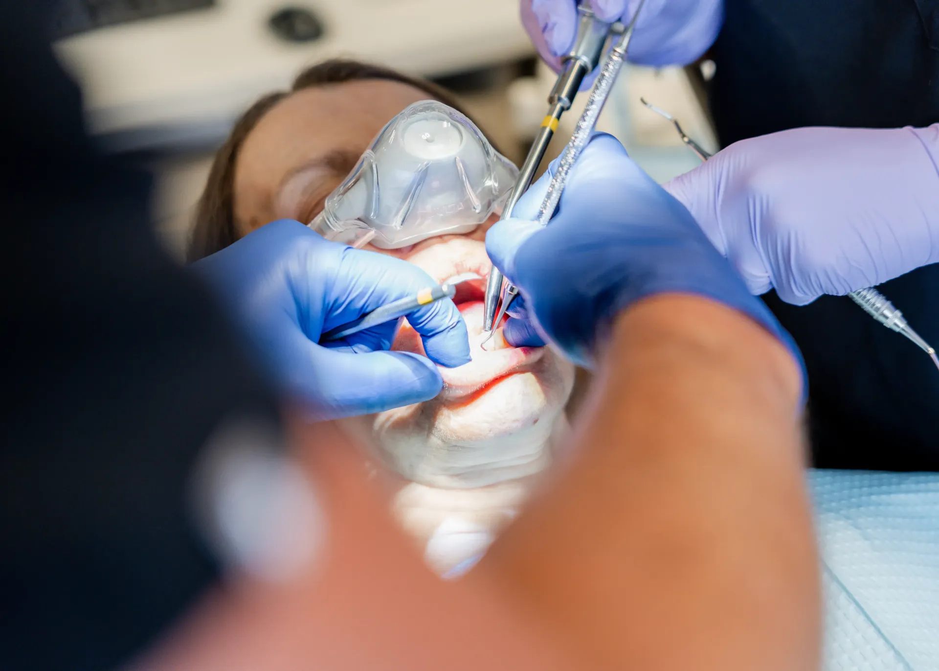 Dental procedure: Patient with oxygen mask, dental tools in mouth, gloved hands working.