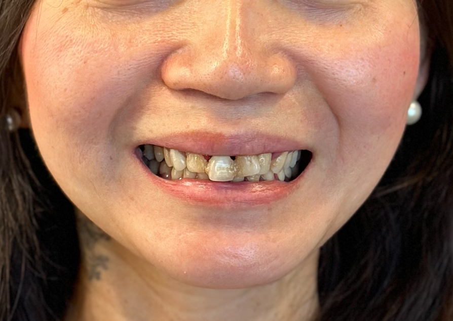 Woman smiling, revealing damaged, discolored teeth in close-up shot.