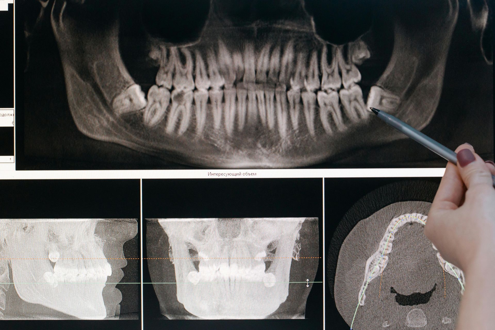 Dental X-ray showing teeth and jaw, hand pointing to a tooth. Several views of the scan are visible.