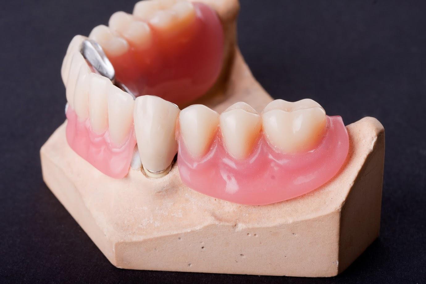 Dentures — Sample Dentures in Washington, DC