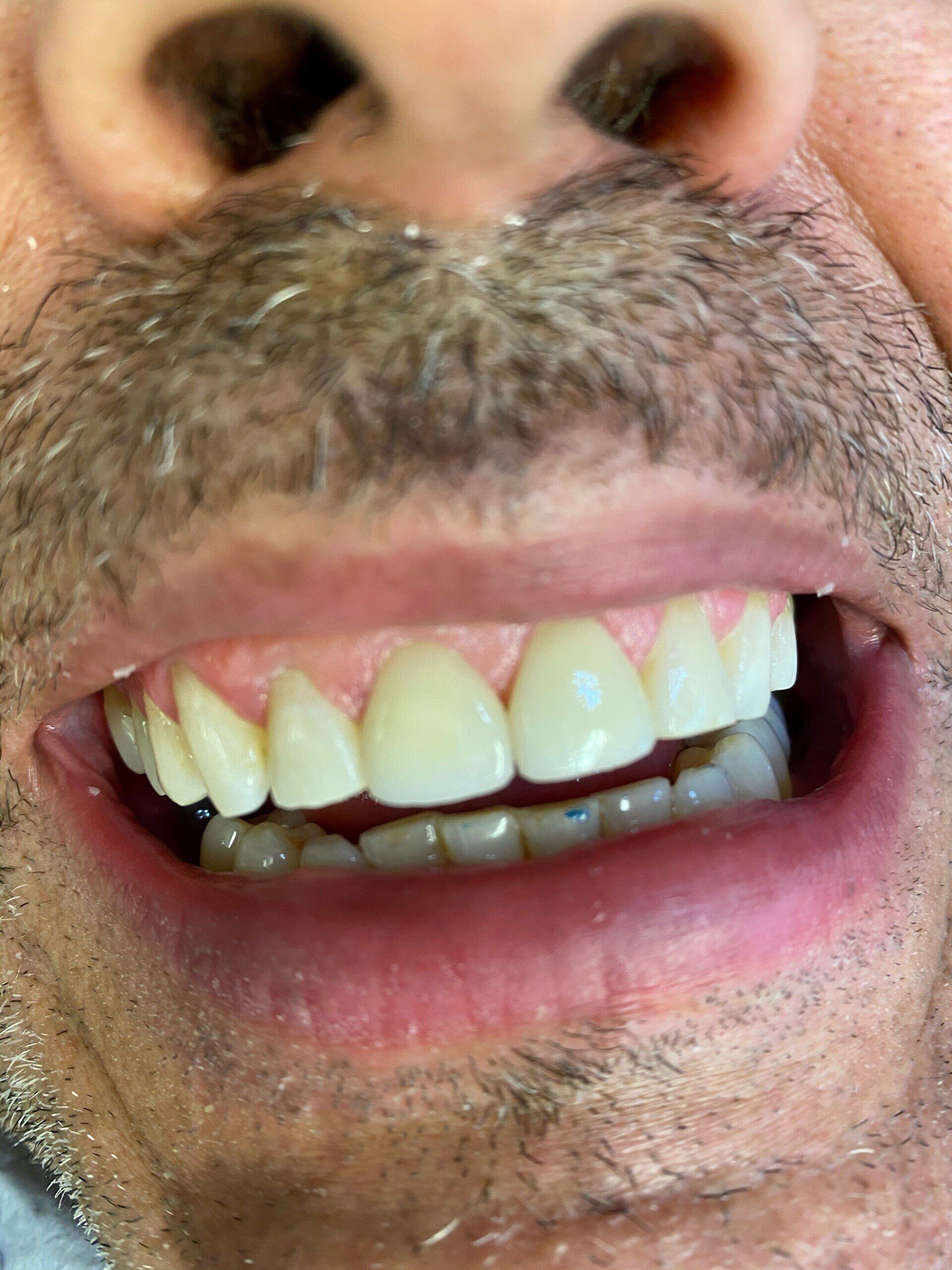 After image of patient 1 — Washington, DC — Michael G. Landy, DDS.