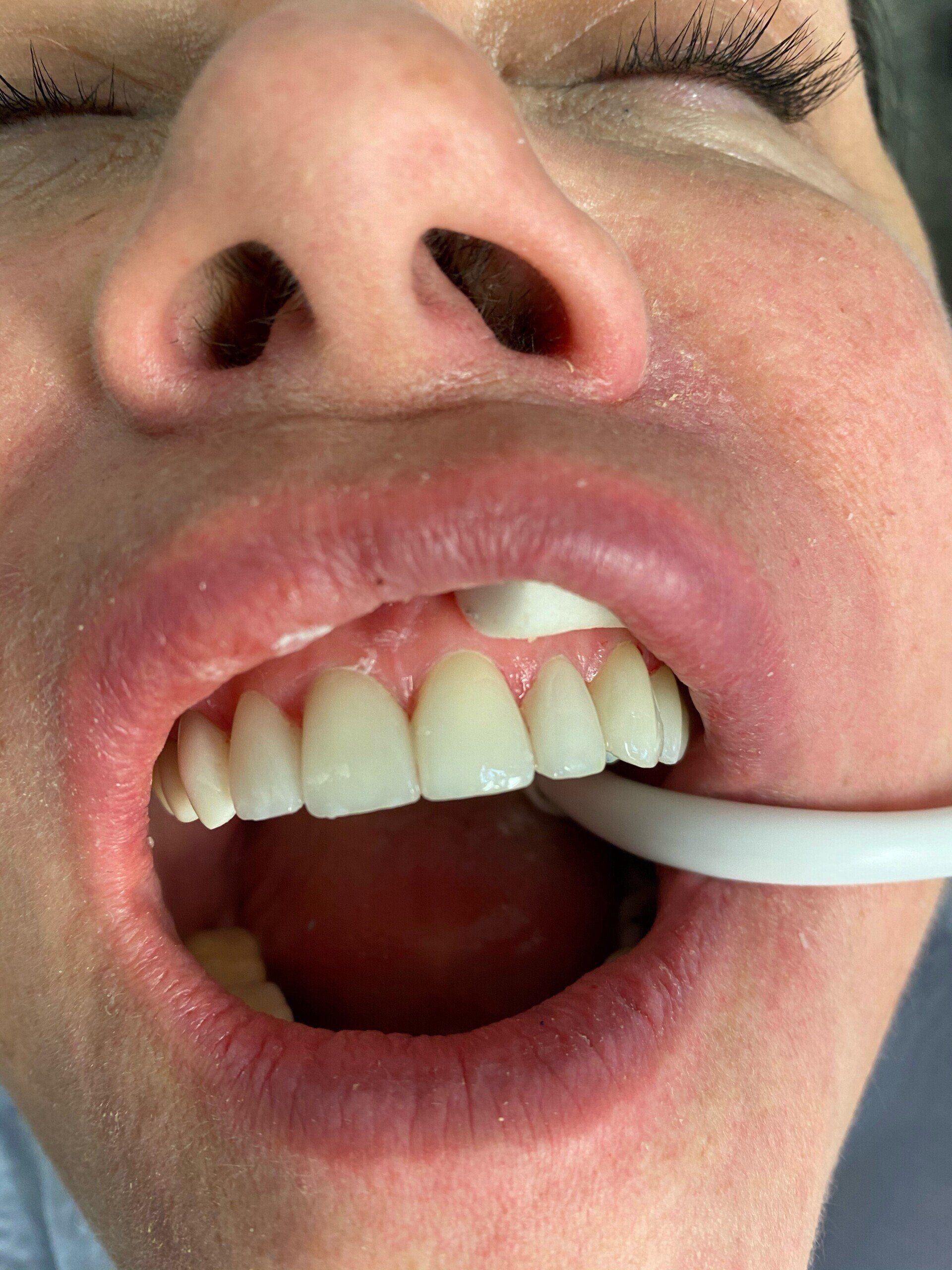 After image of patient 3 — Washington, DC — Michael G. Landy, DDS.