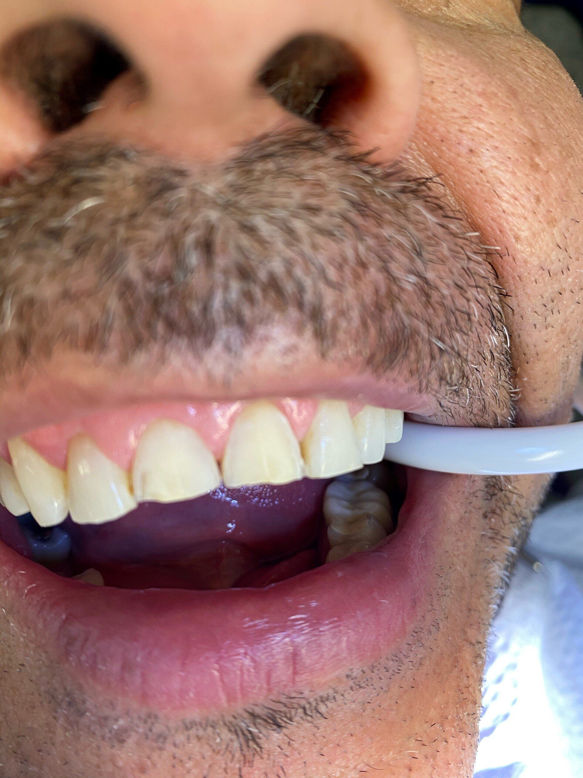 Before image of patient 1 — Washington, DC — Michael G. Landy, DDS.