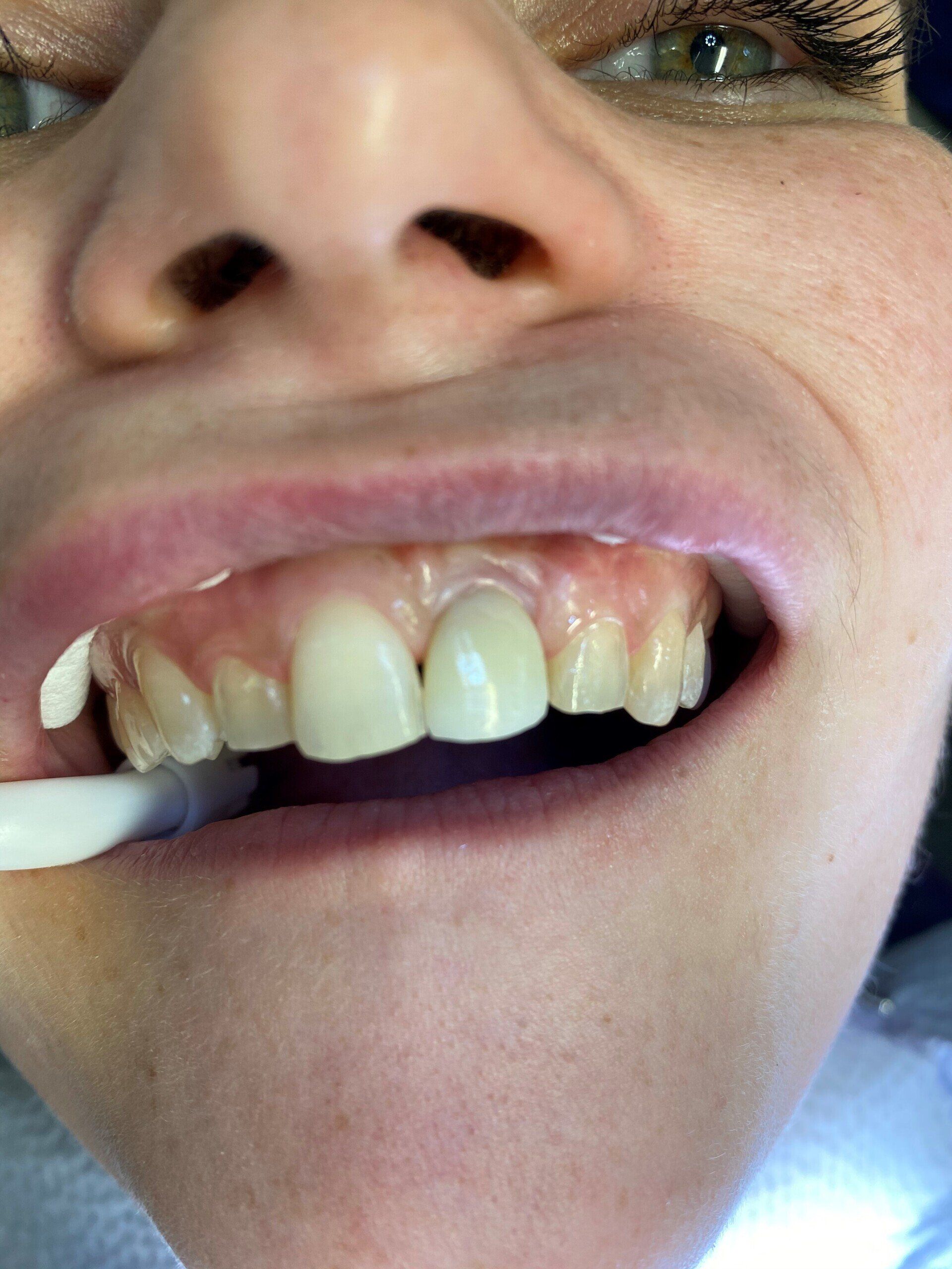 Before image of patient 2 — Washington, DC — Michael G. Landy, DDS.