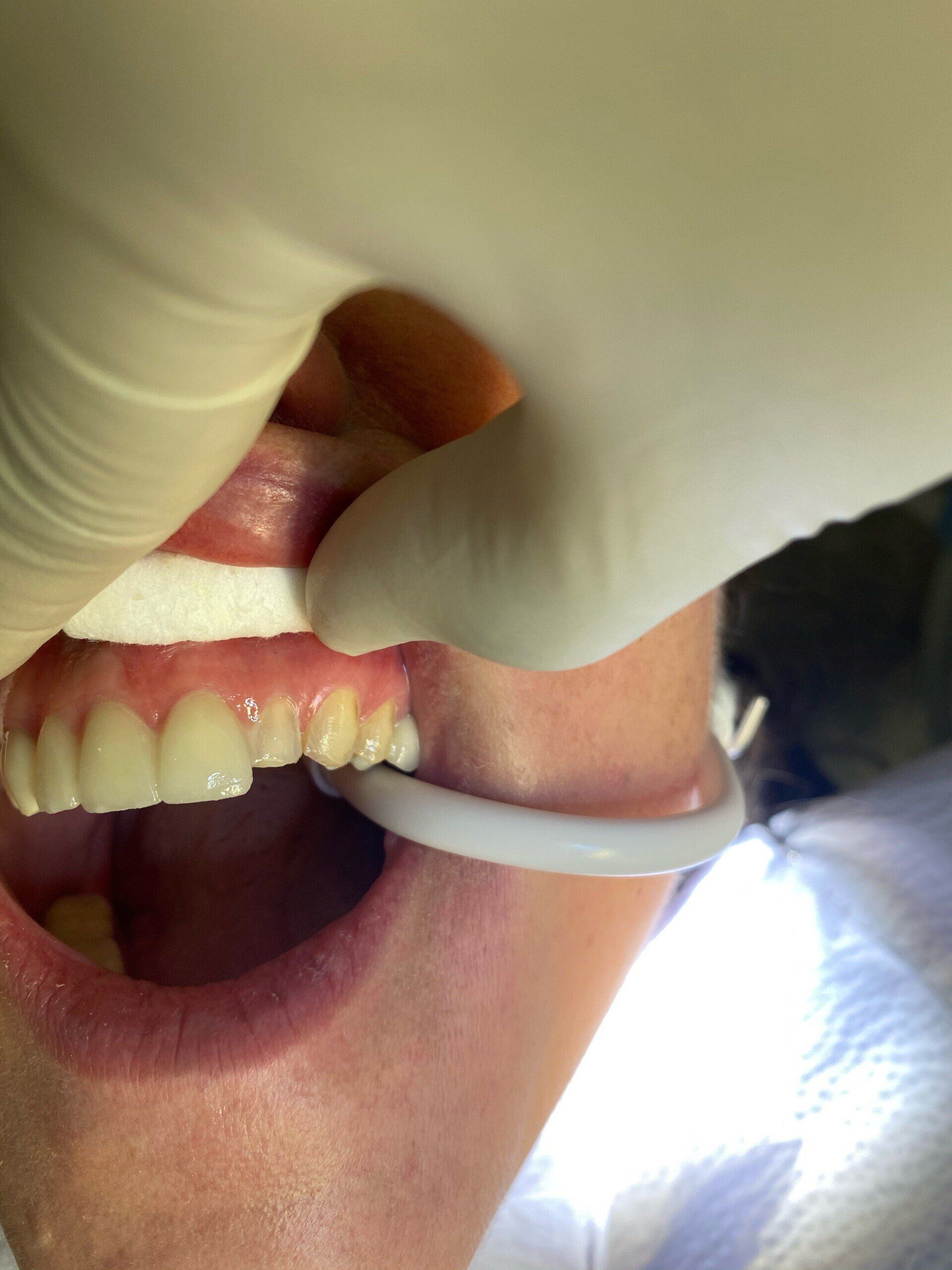 Before image of patient 3 — Washington, DC — Michael G. Landy, DDS.