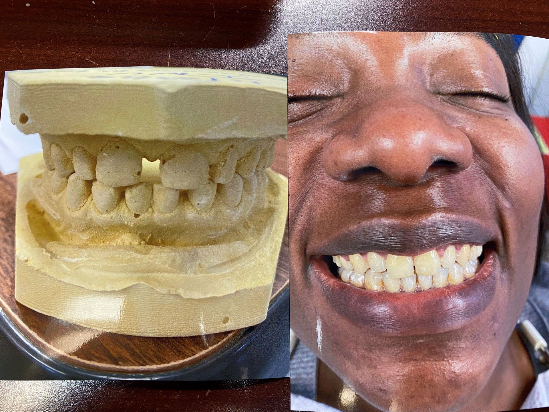 Invisalign Before and After — Washington, DC — Michael G. Landy, DDS.
