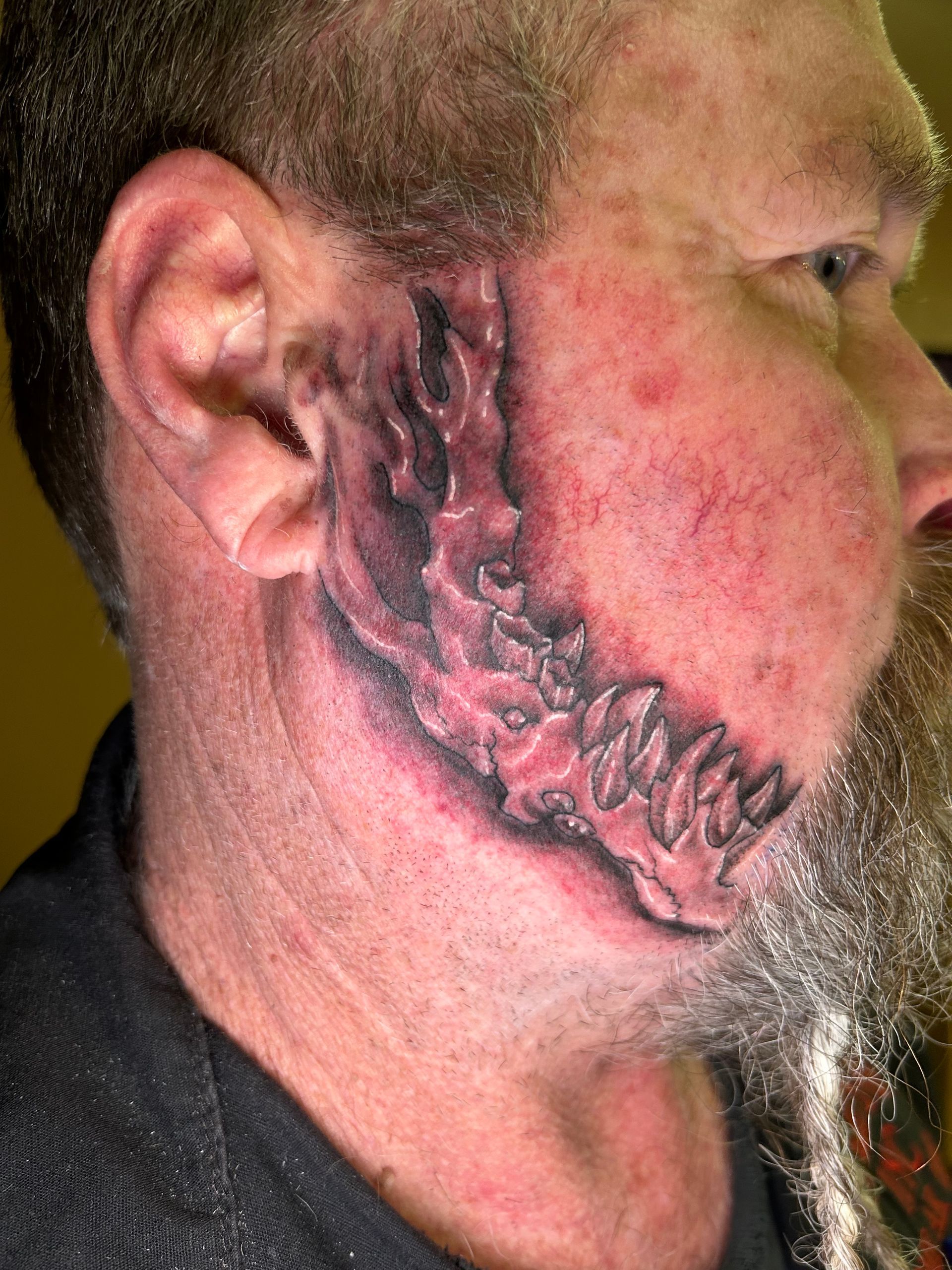 Man with a tattoo on his cheek depicting a monster jaw; red skin around tattoo.