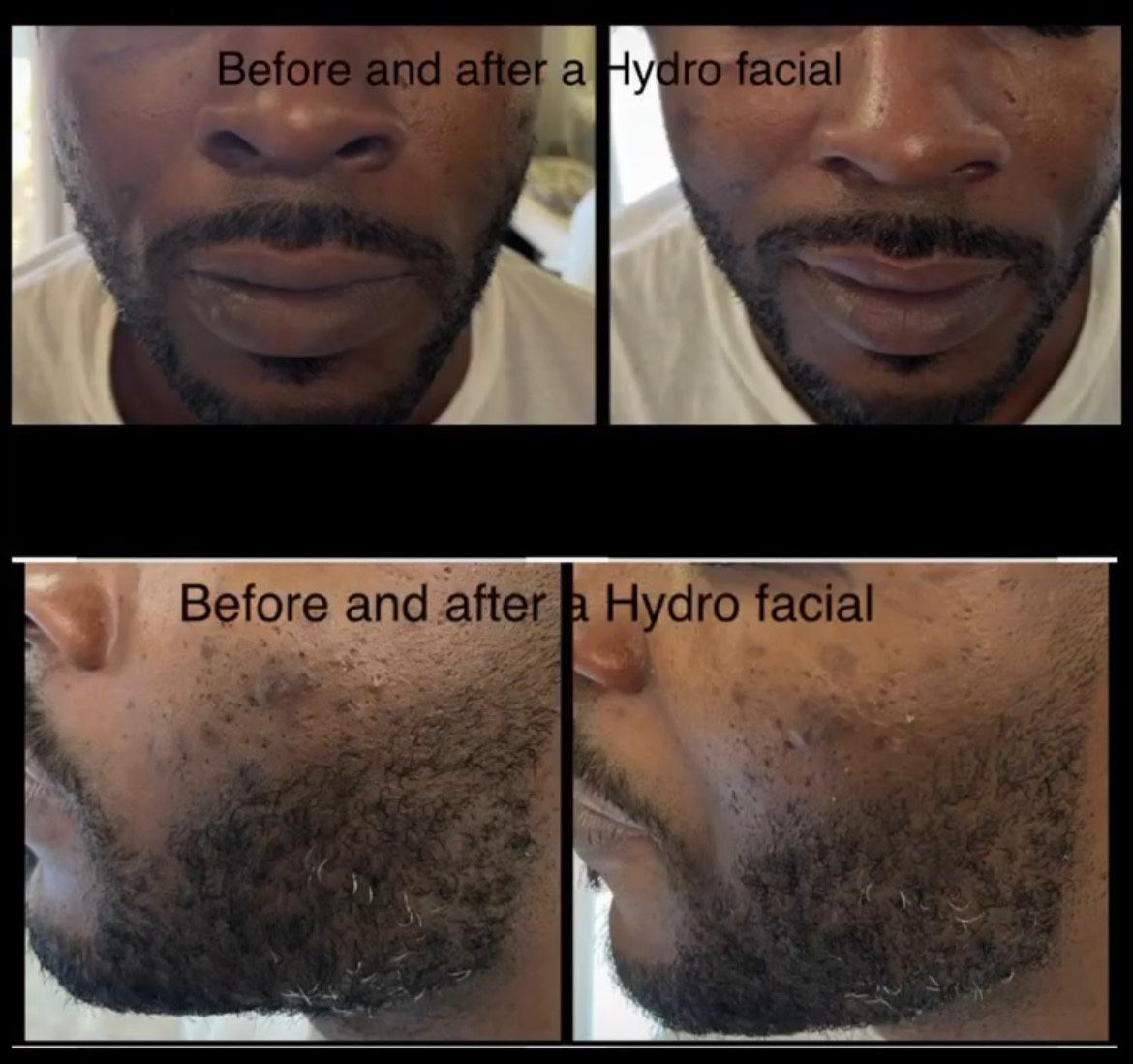 Before and after hydro facial on a Black man; face shows improved skin texture.