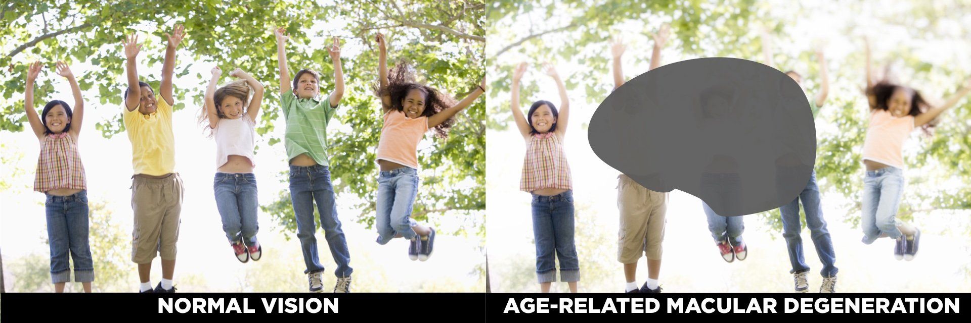 view of children with normal vision vs Macular Degeneration
