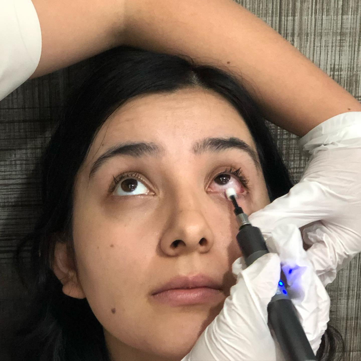 young woman getting treatment with Blephex