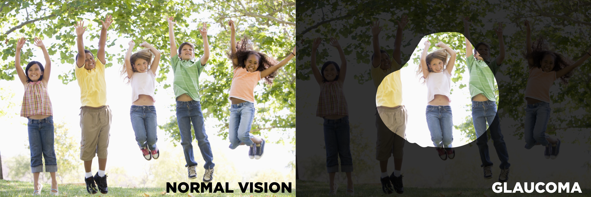 simulated vision of children normal vs glaucoma