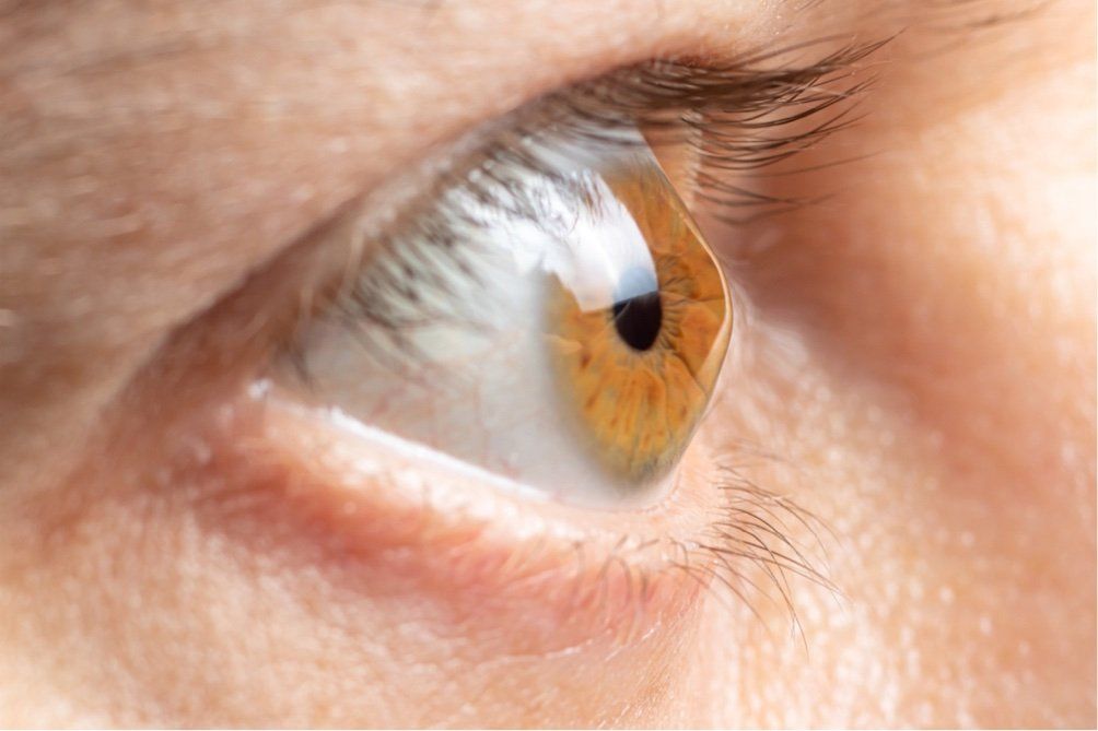A close up of a person 's brown eye with keratoconus
