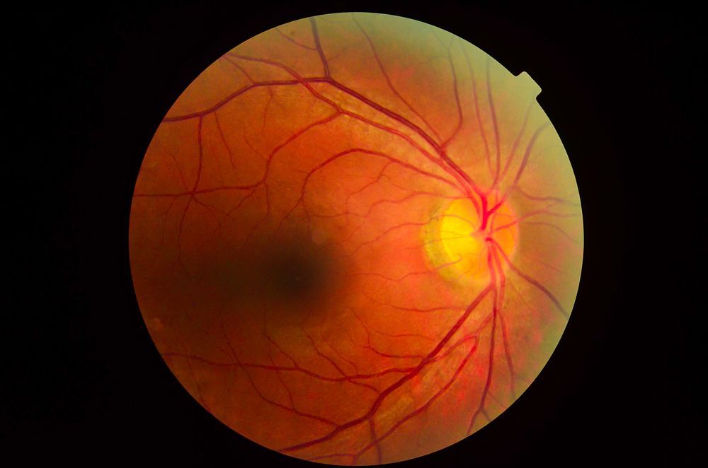 Diabetic Retinopathy is a preventable complication of diabetes.