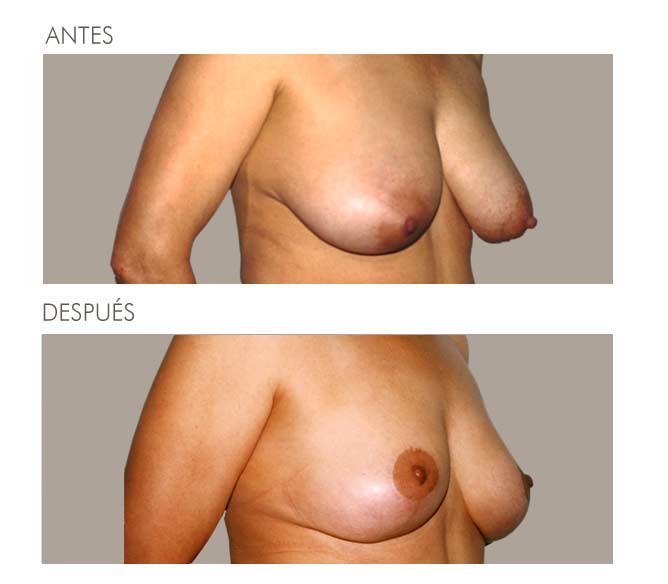 MAMOPLASTIA DE REDUCCIÓN