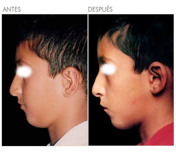 A before and after photo of a young boy 's face