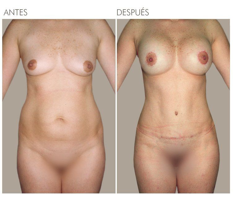 ABDOMINOPLASTIA