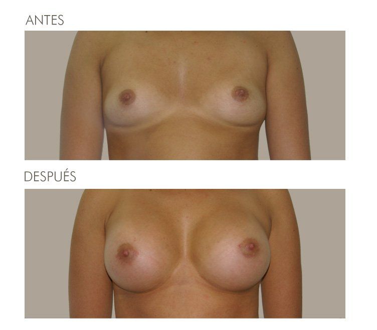 MAMOPLASTIA DE AUMENTO