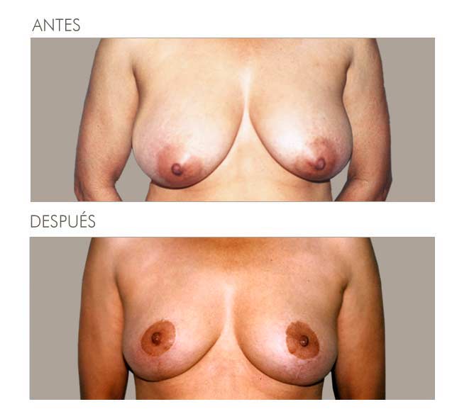 MAMOPLASTIA DE REDUCCIÓN