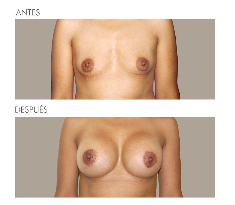 MAMOPLASTIA DE AUMENTO