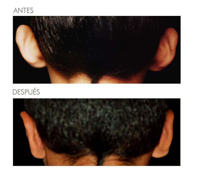A before and after picture of a person 's ears