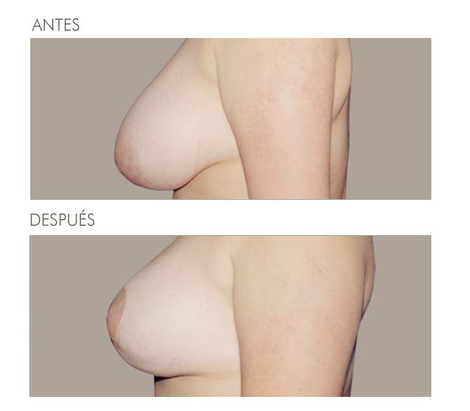 MAMOPLASTIA DE REDUCCIÓN