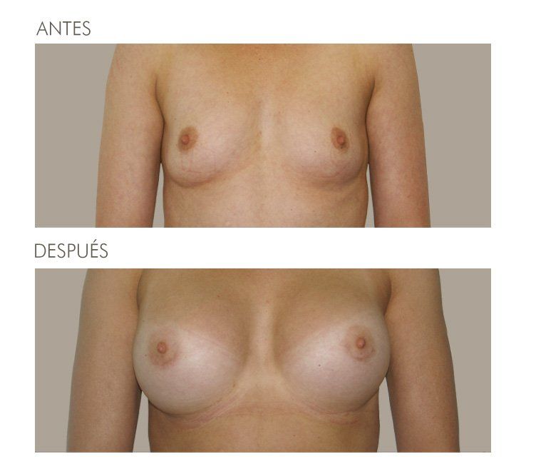 MAMOPLASTIA DE AUMENTO