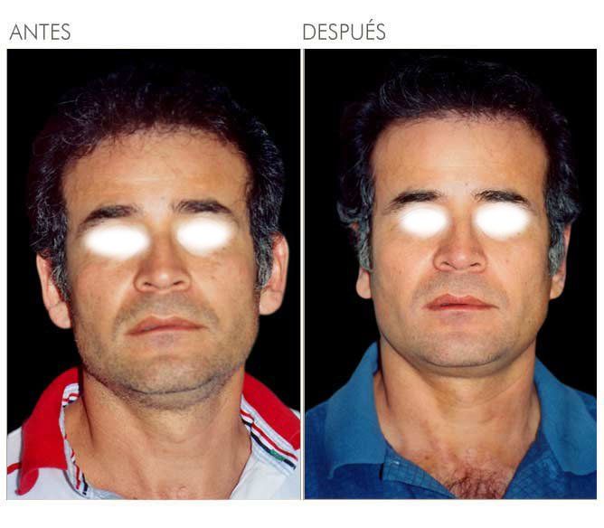 A before and after photo of a man 's face