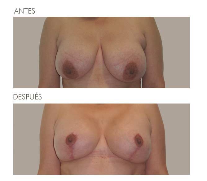 MAMOPLASTIA DE REDUCCIÓN