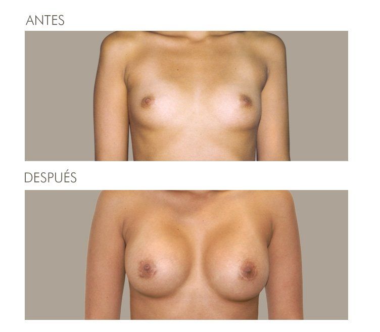 MAMOPLASTIA DE AUMENTO