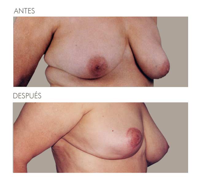 MAMOPLASTIA DE REDUCCIÓN