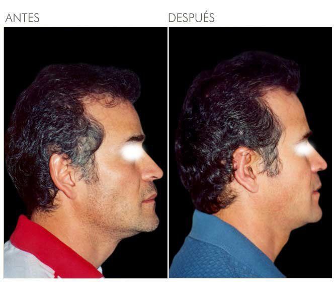 A before and after photo of a man 's face