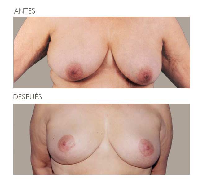MAMOPLASTIA DE REDUCCIÓN