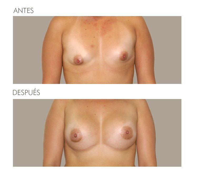 MAMOPLASTIA DE AUMENTO