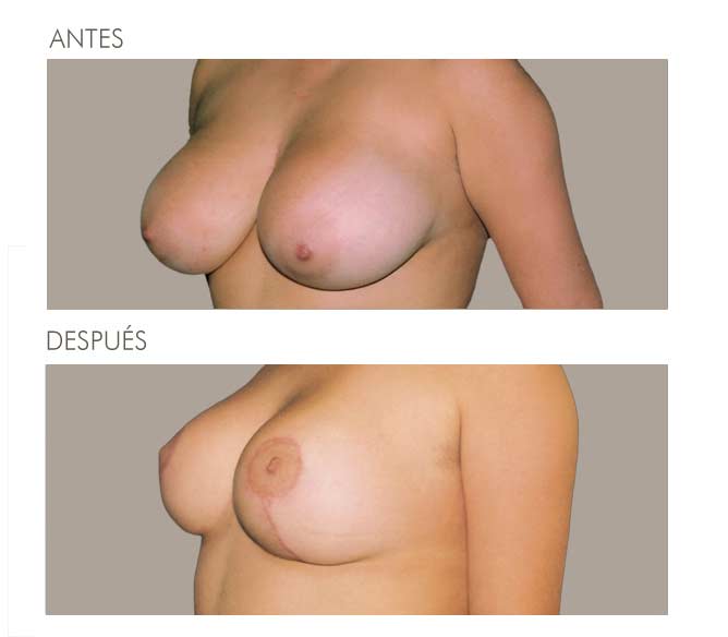 MAMOPLASTIA DE REDUCCIÓN