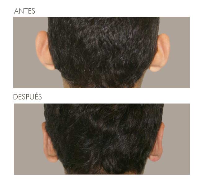 A before and after picture of a man 's ears