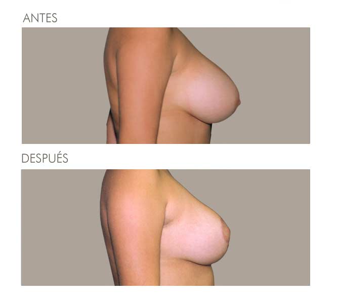 MAMOPLASTIA DE REDUCCIÓN
