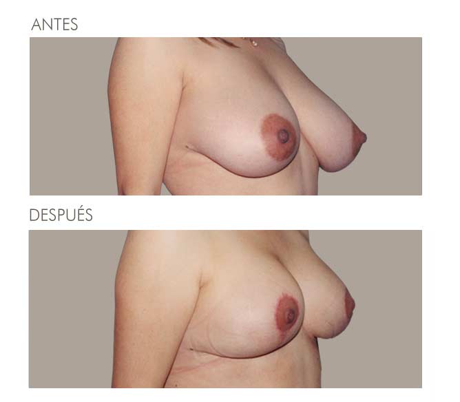 MAMOPLASTIA DE REDUCCIÓN