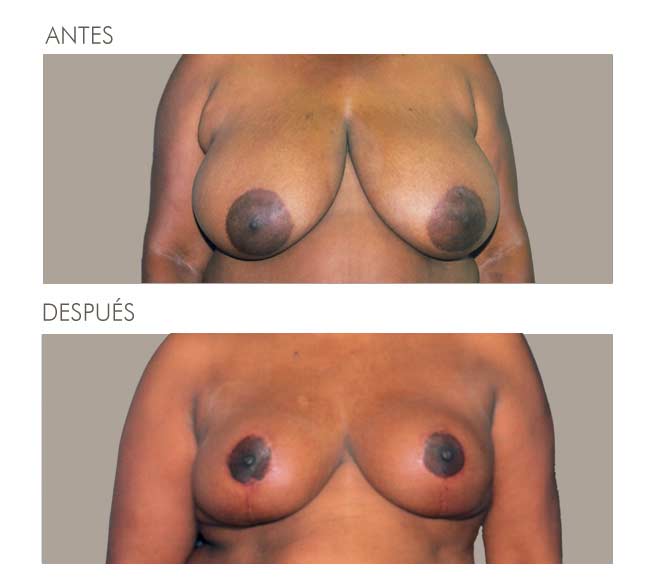 MAMOPLASTIA DE REDUCCIÓN