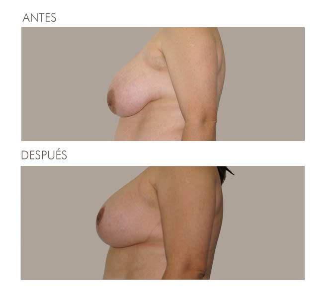 MAMOPLASTIA DE REDUCCIÓN