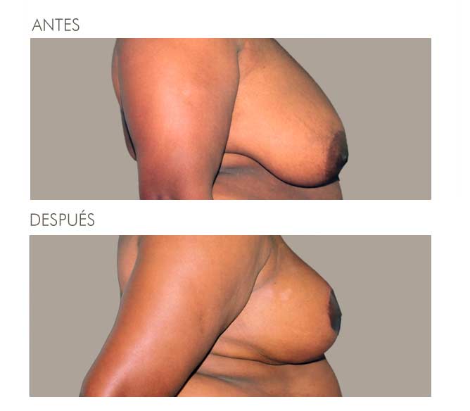 MAMOPLASTIA DE REDUCCIÓN