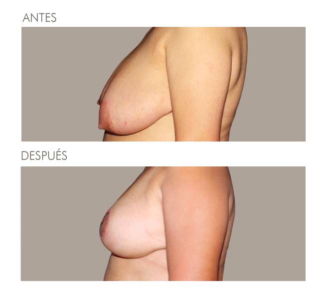 MAMOPLASTIA DE REDUCCIÓN