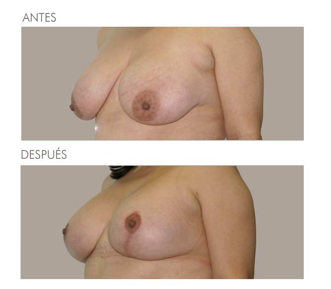 MAMOPLASTIA DE REDUCCIÓN