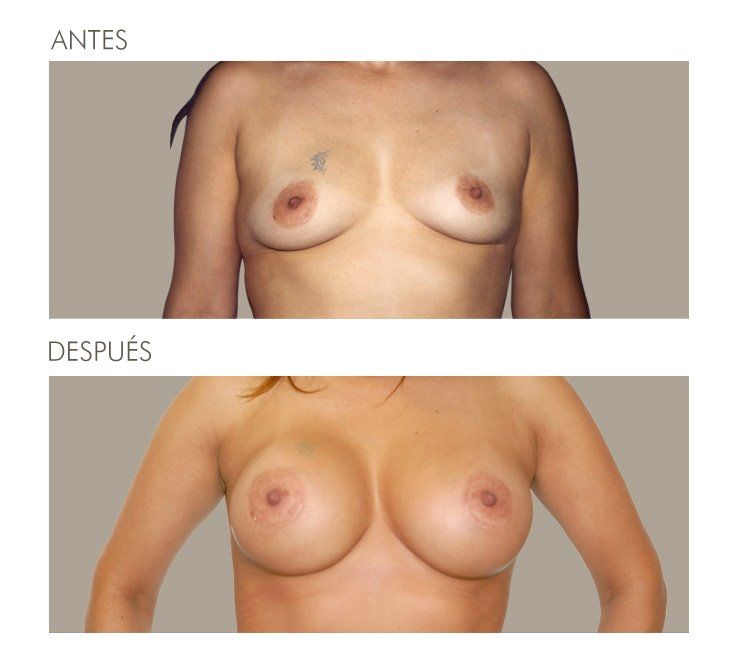 MAMOPLASTIA DE AUMENTO