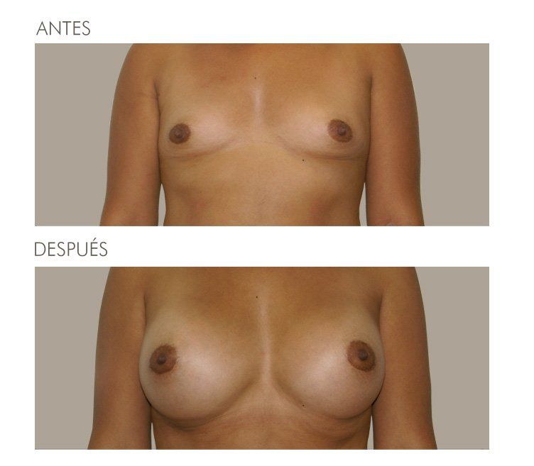 MAMOPLASTIA DE AUMENTO